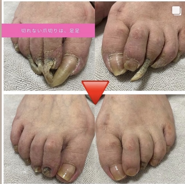 変形爪症例