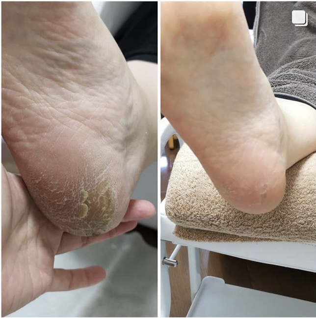 かかとの角質