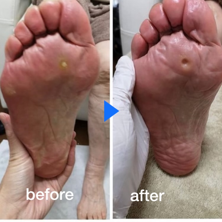 魚の目ケアのビフォーアフター